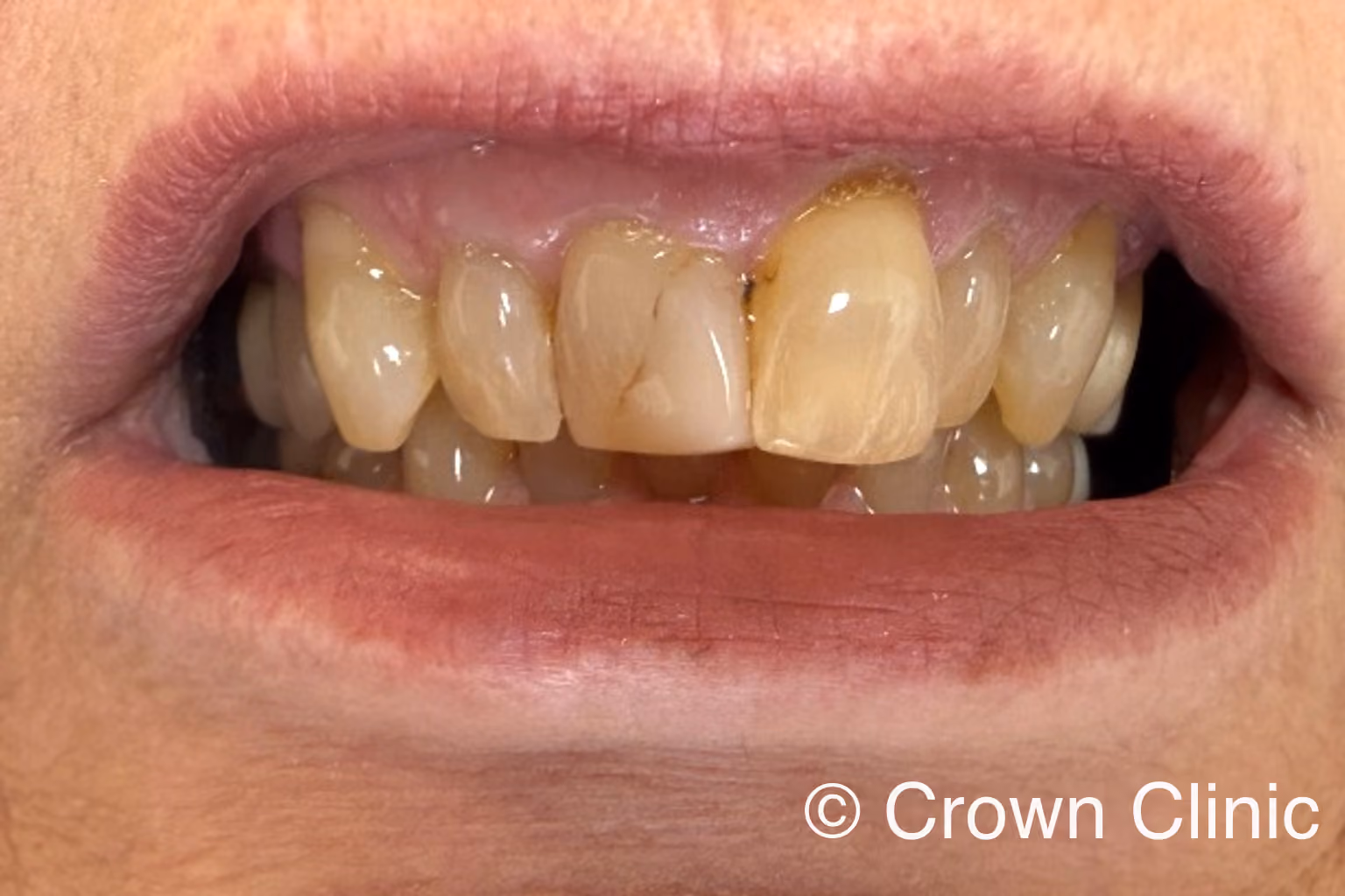 Close-up smile showing heavily worn, discolored, and uneven upper front teeth before a same-day CEREC zirconia smile makeover
