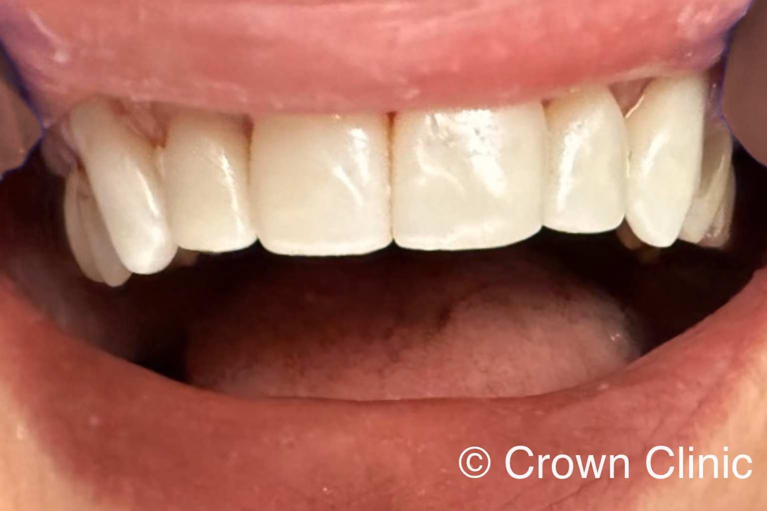 Close-up smile showing six bright, natural-looking upper front CEREC zirconia crowns placed in a single visit